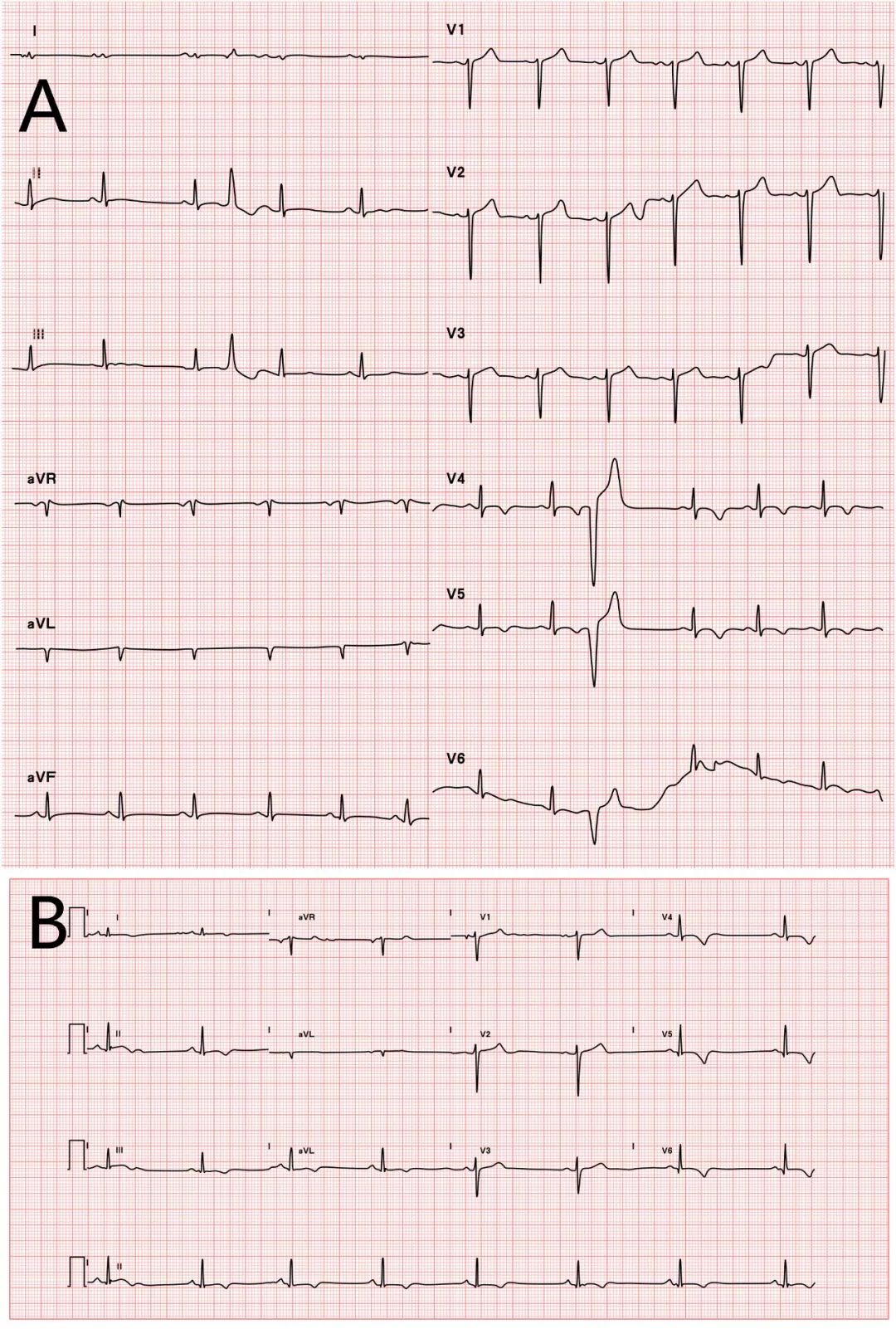 a:   患者1984年(26岁)心电图提示v4~v6导联和下壁导联t波倒置;   b
