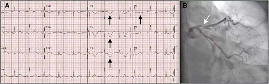 胸痛時出現胸前導聯t波對稱性倒置,冠脈造影可見前降支近端閉塞