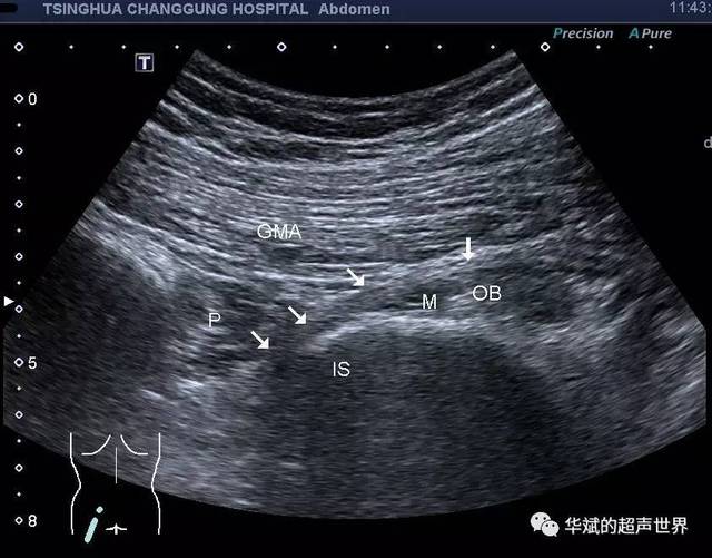 神经超声解剖臀部坐骨神经