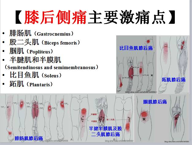 肌筋膜疼痛触发点全身分布图头颈肩腰腿痛