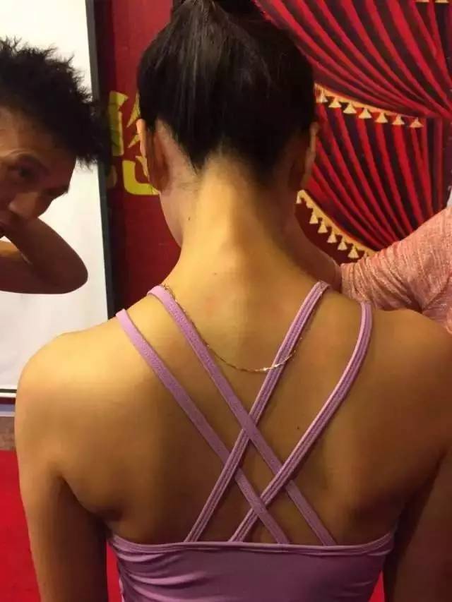 脊柱侧弯,圆肩驼背的瑜伽理疗操作方法(瑜伽课件分享)