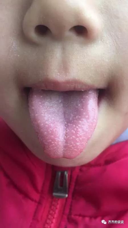 舌苔芒刺图片