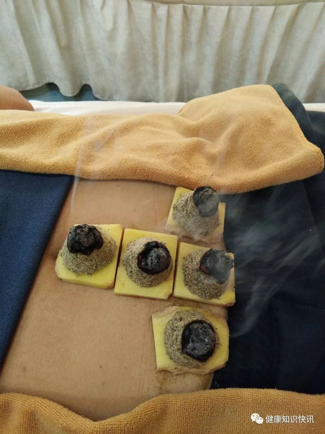 灸透这四穴,祛除一身之疾