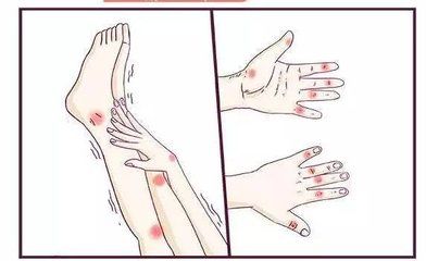 总令人难以启齿的梅毒疳疮不要愁中草药方疗效佳