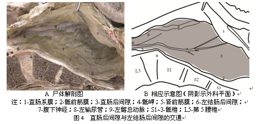 间隙:轻轻向前牵引直肠,可见在直肠系膜和骶前筋膜之间存在一个潜在的