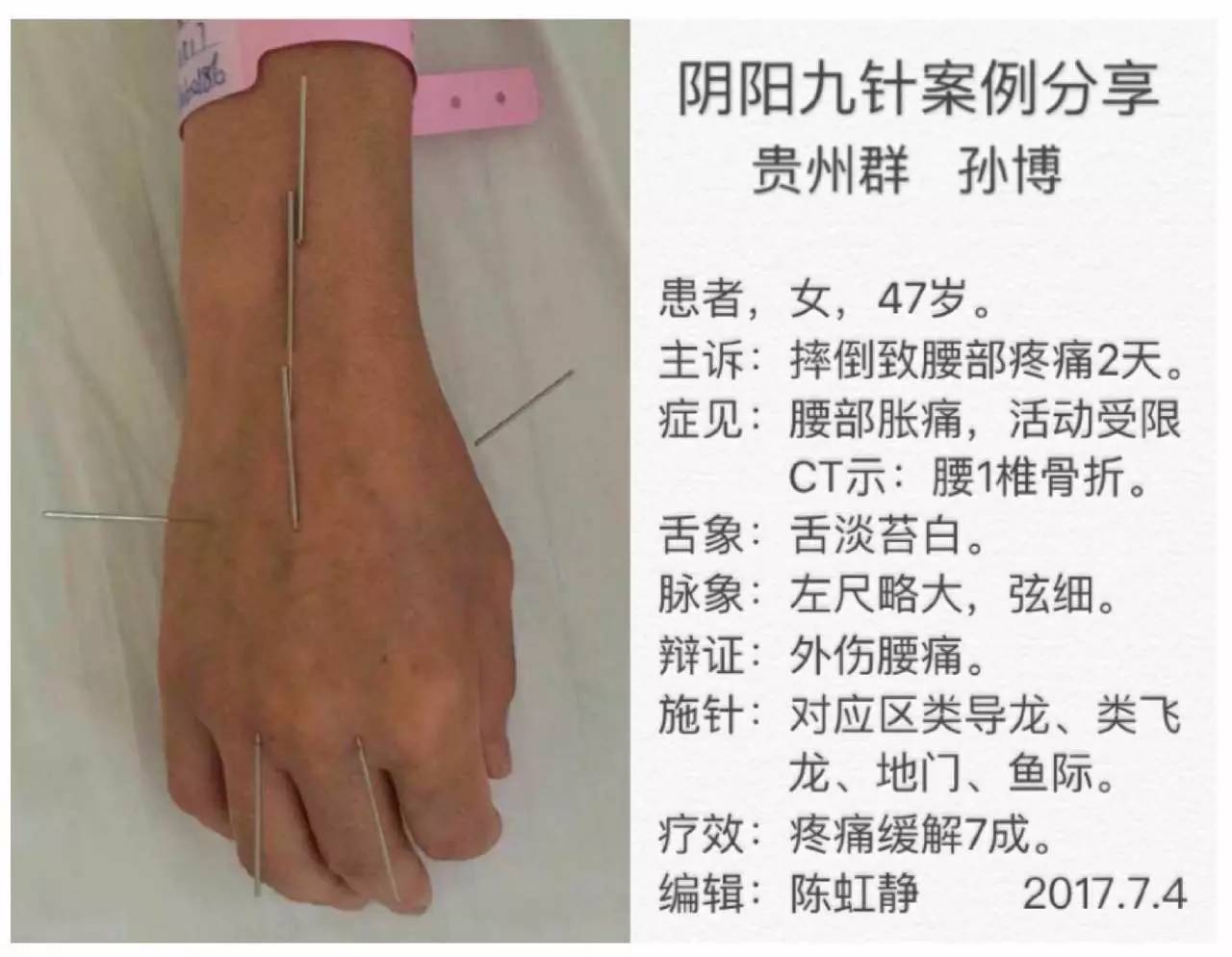 阴阳九针日报(2017.7.8)