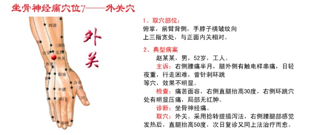 神闕拔罐更神奇針灸治療坐骨神經痛治療圖合谷穴應用一得治療急性腰