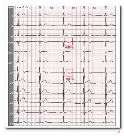 t波正常心电图:图3-145(7)其它:右侧胸导联t波正向后,其左侧胸导联不