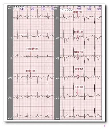 山羊老师课程常见心电图基础知识讲座第十一讲t波分析