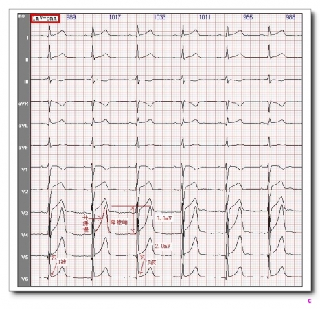山羊老师课程常见心电图基础知识讲座第十一讲t波分析