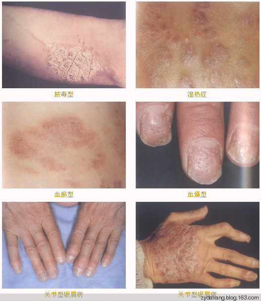 此方治白庀(银屑病) 百发百中