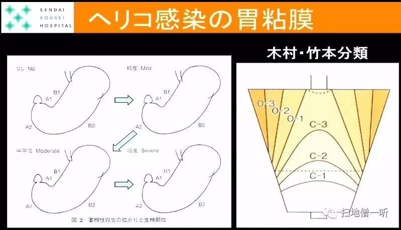 如于胃角处观察到则提示无萎缩hp未感染粘膜提示像包括:胃