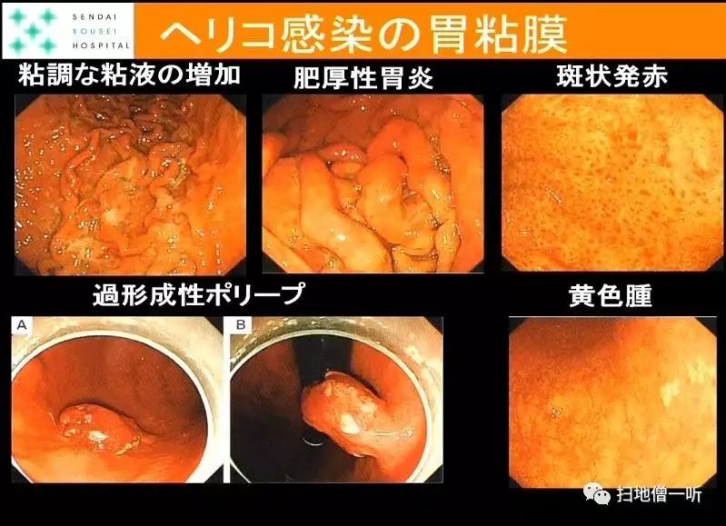 竹本将萎缩性胃炎按萎缩部位分为闭合性和开放性,即c-ohp感染胃粘膜像
