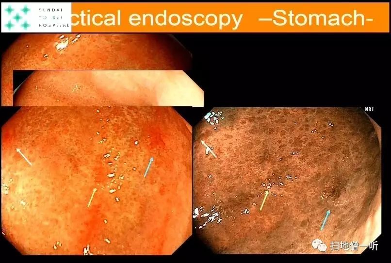 粘膜增厚(铺路石样改变),斑状地图状发红除菌后胃癌特点:背景粘膜的