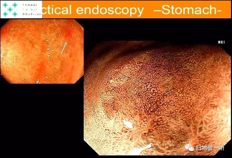 医学美图:平泽大讲早癌内镜检查(周末大餐) - 好网角收藏夹