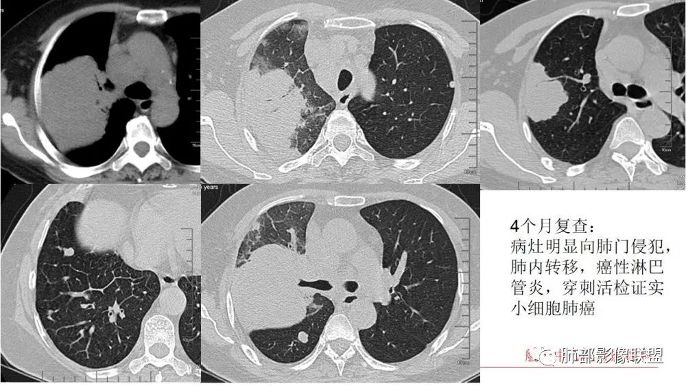 【于海涛专题讲座】以微细解剖为基础肺癌ct诊断