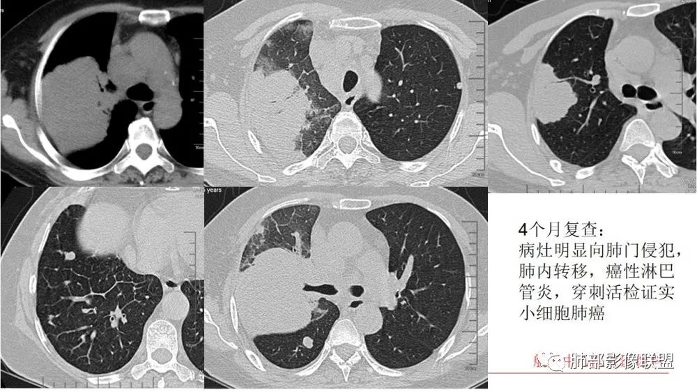 早期肺癌ct图图解影像图片