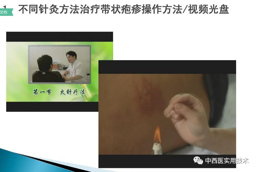 带状疱疹的针灸治疗