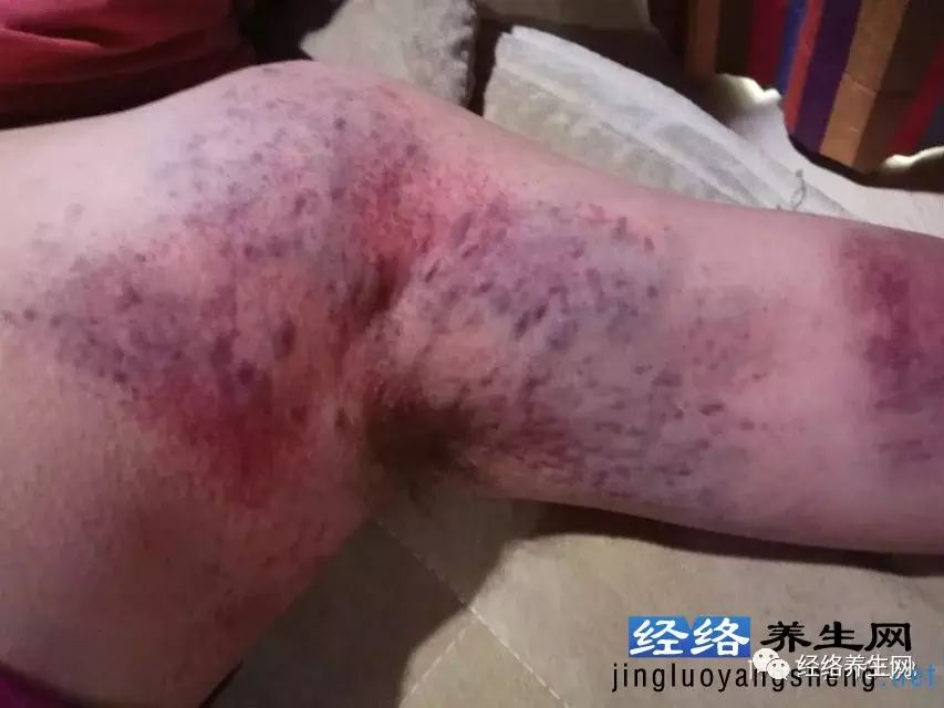 2)拍打手臂外側三焦經,主氣所生病者,非常重要