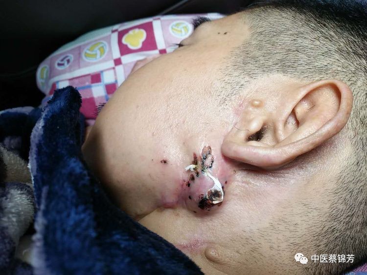 蔡师:面肿的,人早干了.