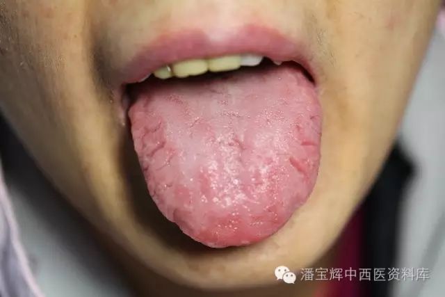 舌脉如何对应?且听李玉宾讲解舌诊与五行,有图有方有真相