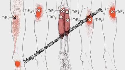 胫骨后肌激痛点图片