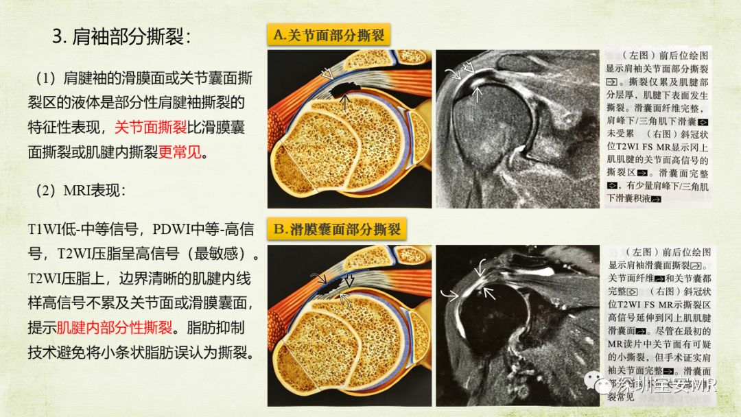 肩關節mri診斷第二部分