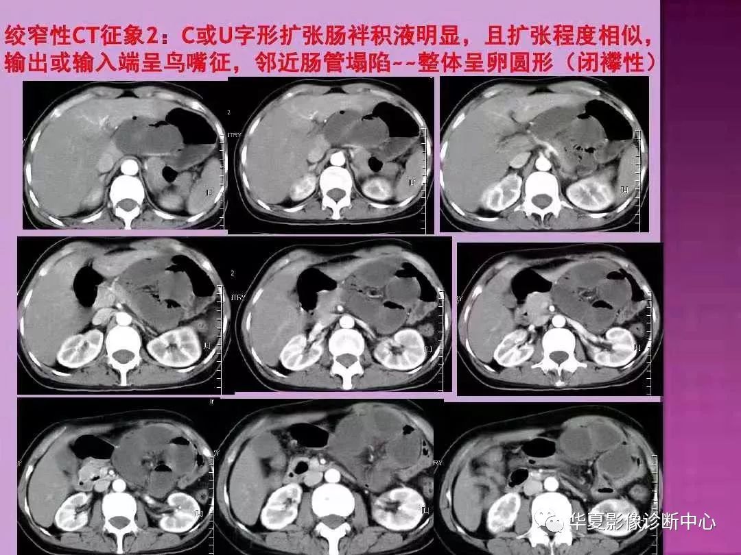 ct上如何寻找肠梗阻的梗阻点