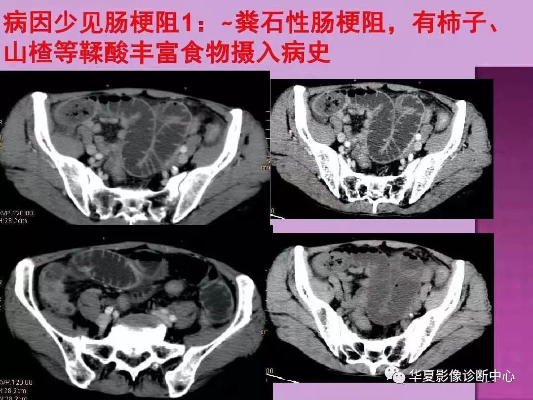 ct上如何尋找腸梗阻的梗阻點