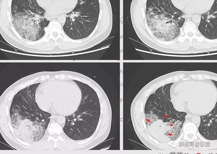 【每日晨读】云里雾里寻踪迹(三)(不按常规出牌的肺炎)
