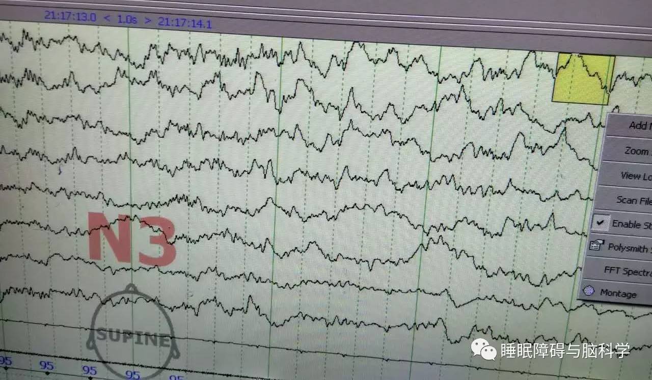 美国睡眠医学学会eeg睡眠分期最详入门解读配图