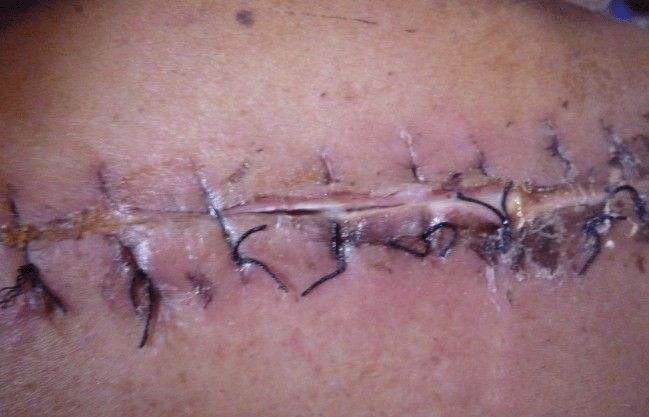 阑尾炎手术切口图片