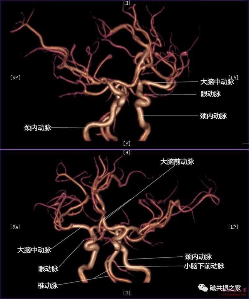 正常mra图像脑血管分段图片