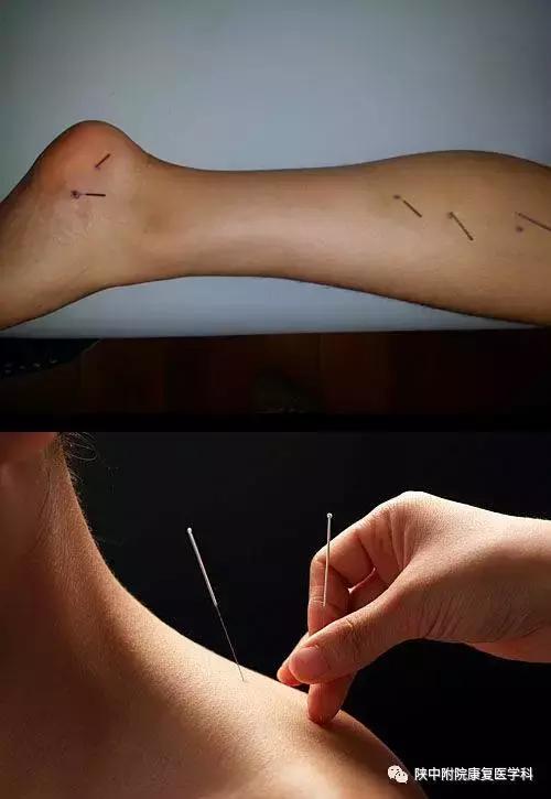 治疗疼痛的触发点针刺疗法您知道吗?
