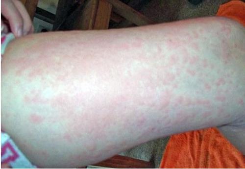 2天搞定2年全身瘙痒艾叶居然可以这样用