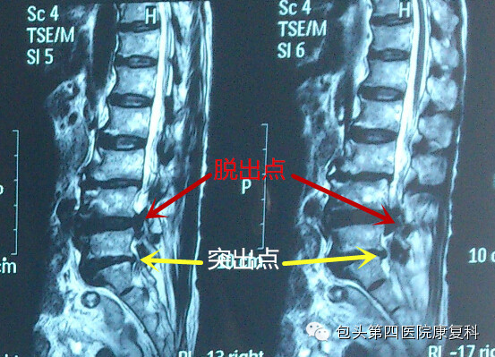 腰椎间盘突出症的影像学检查