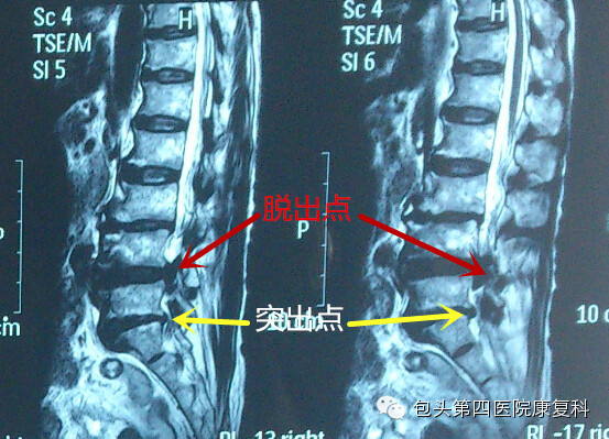 腰间盘突出ct片教程图片