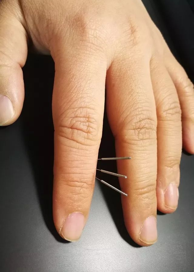 指驷马调理皮肤必用穴董氏针灸穴位解读