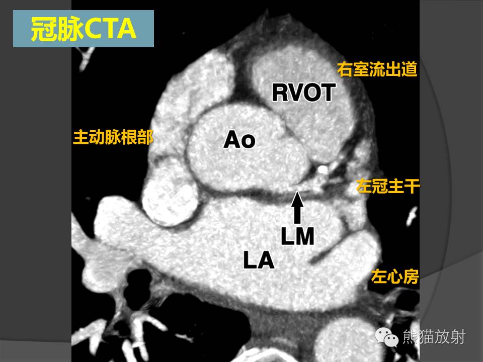 肺动脉cta血管解剖图解图片