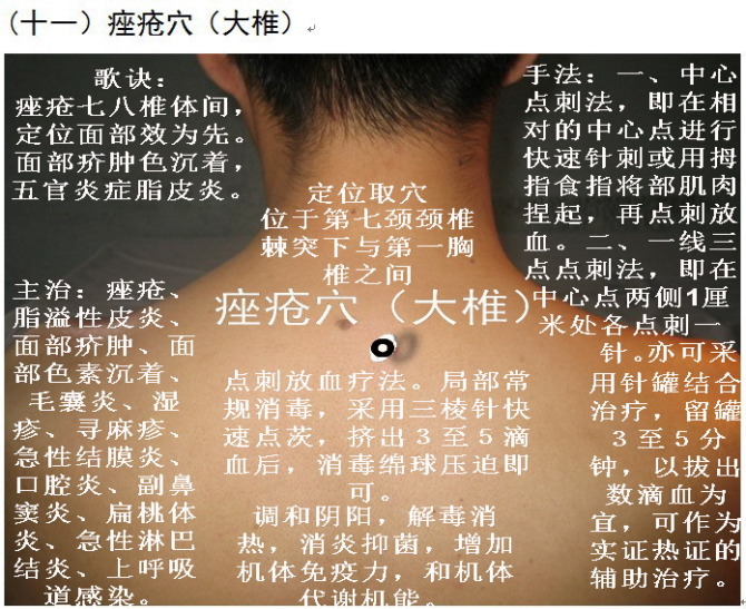 平衡针灸图解