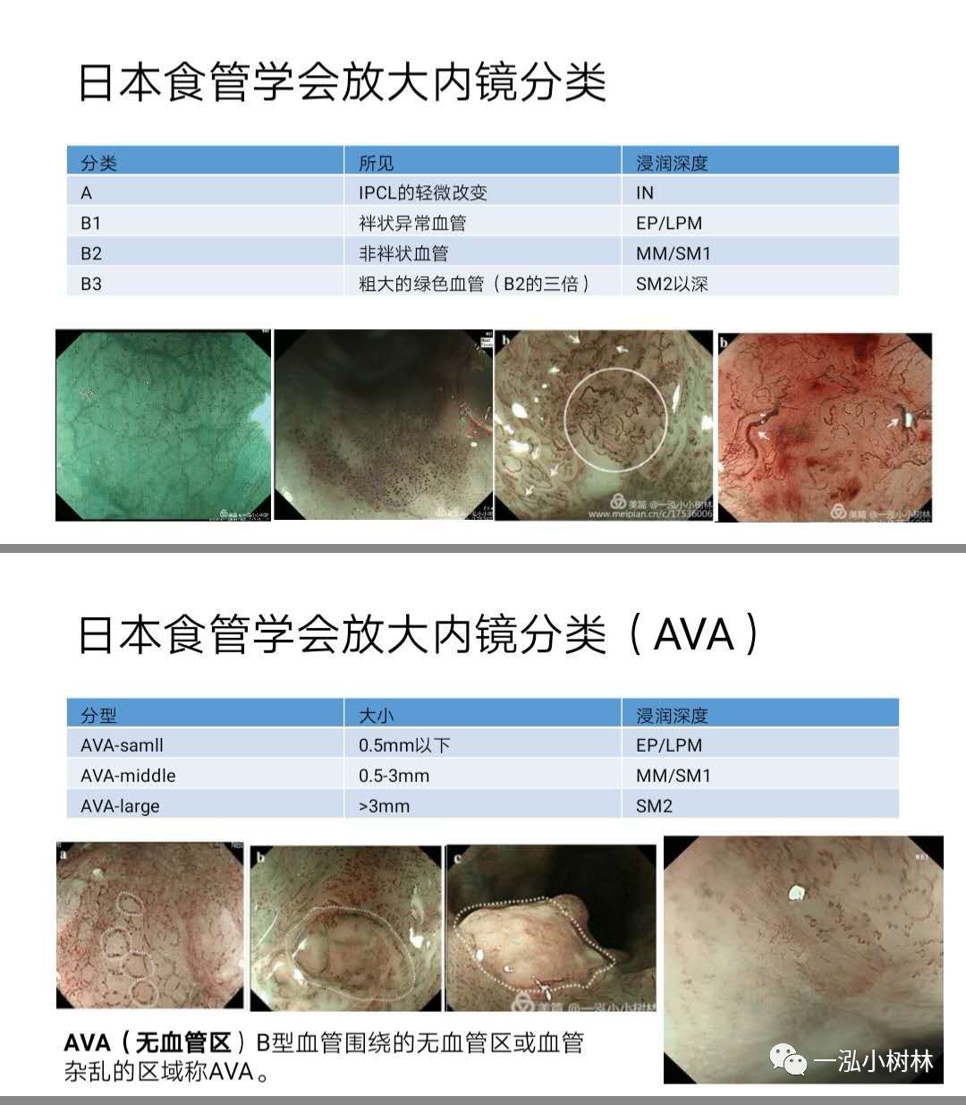 食管早癌病例分享(三)微小食管早癌