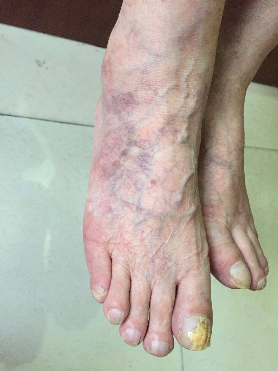 上图为服药一个半月后双脚照片上两图为服药三月后双脚图片(足大趾