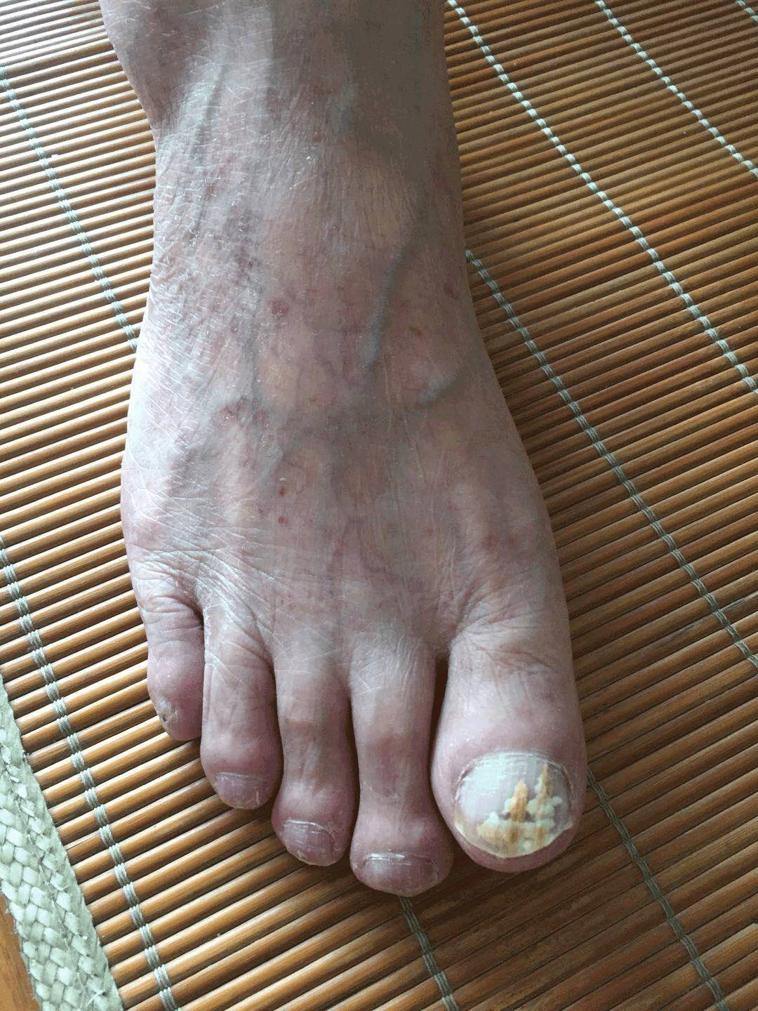 上两图为服药三月后双脚图片(足大趾趾甲已有正常趾甲生出)特别重申