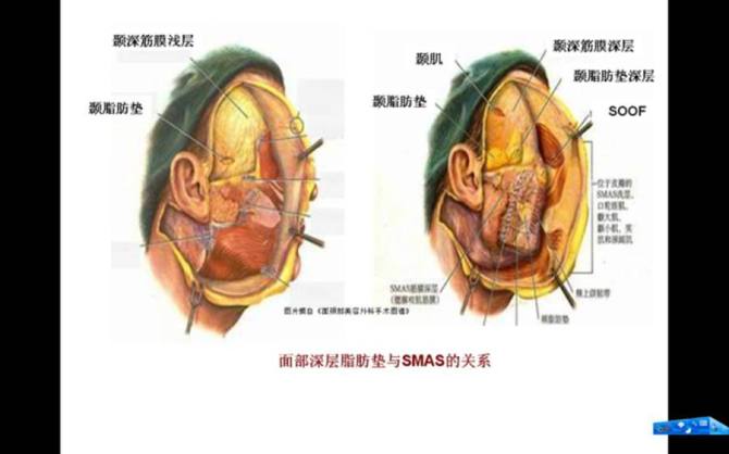 面部的脂肪分佈圖及瘦臉的運用