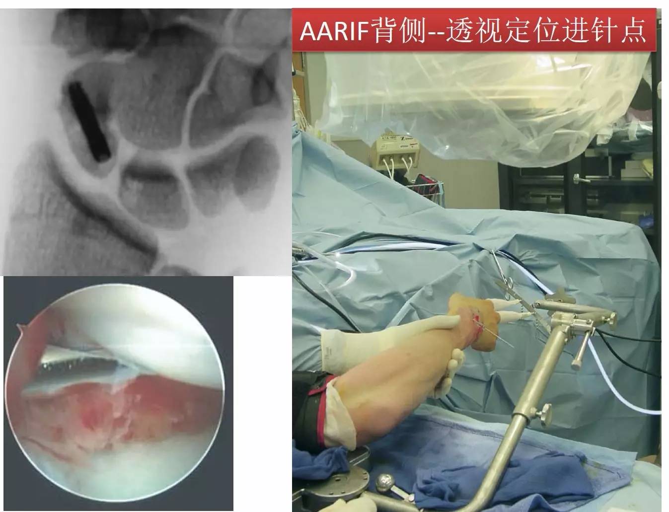 專題教程舟狀骨骨折的7種手術入路詳解