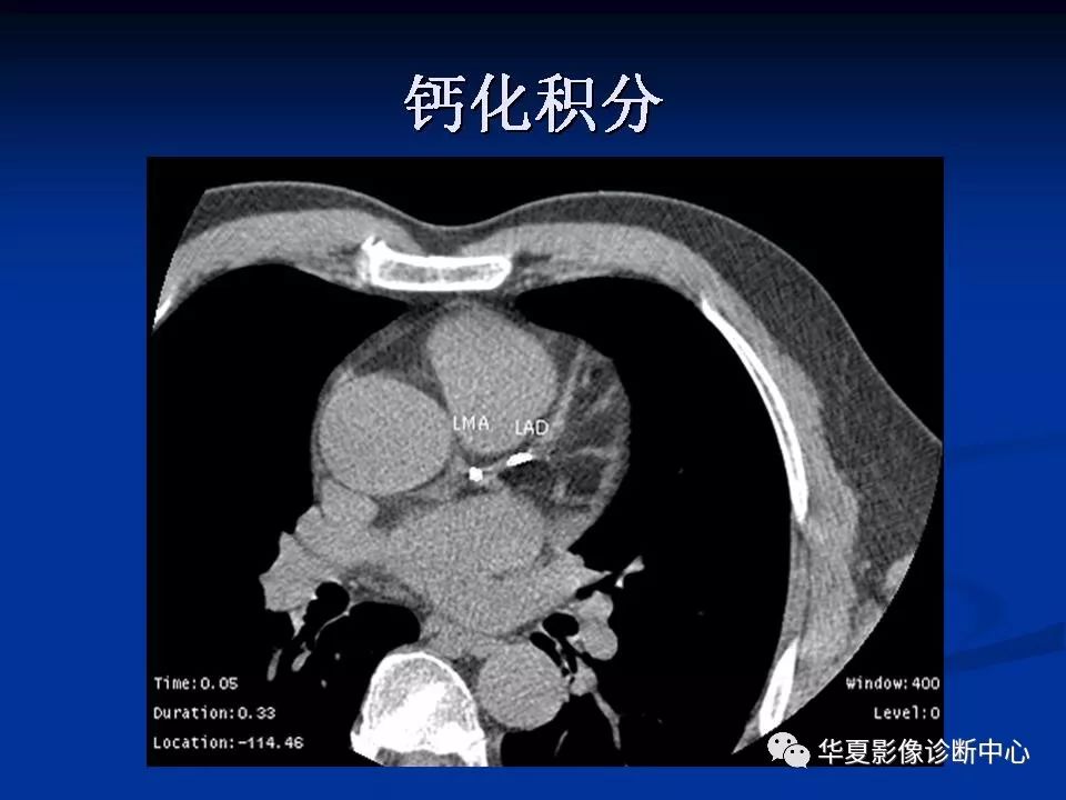 详细解读冠状动脉及冠心病ct