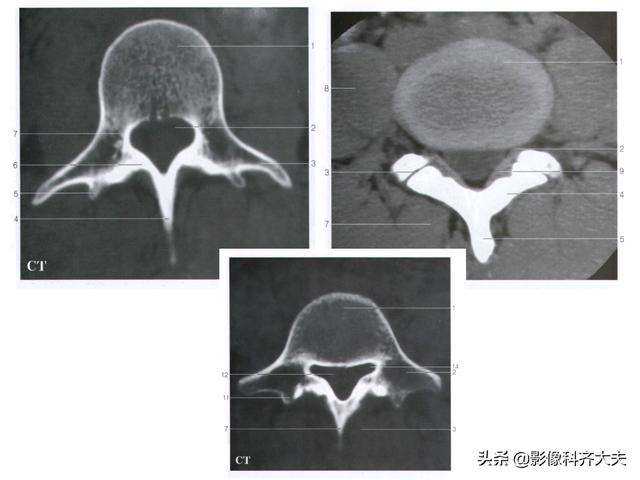 腰椎解剖