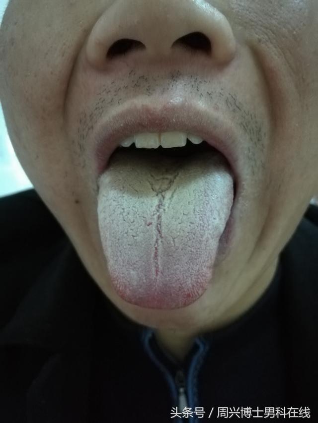 肝胆湿热的舌苔图片图片