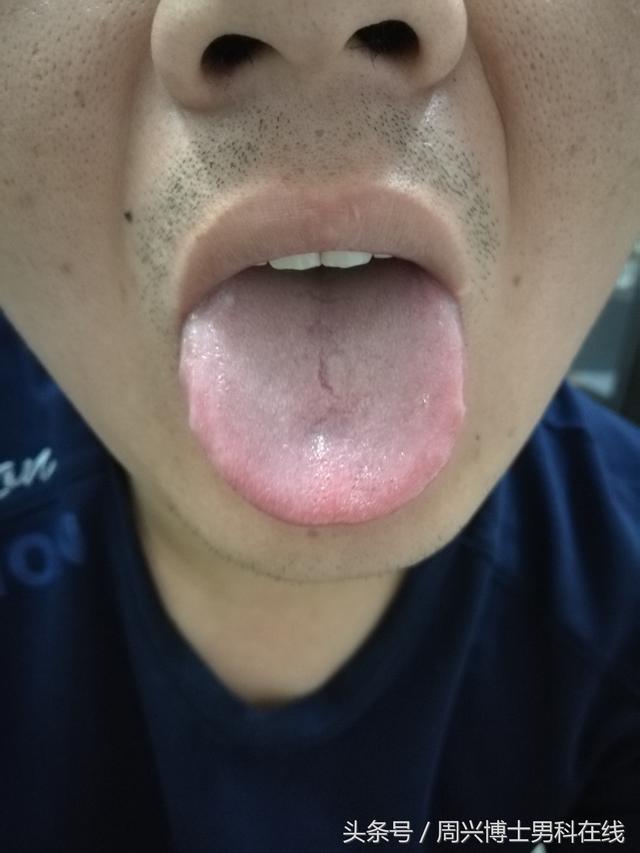 肾虚舌苔的表现图图片
