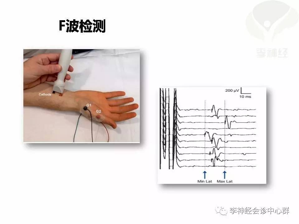 渐冻症肌电图表现图片